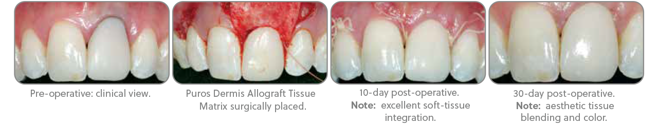 PUROS® DERMIS ALLOGRAFT A Variety of Clinical Advantages