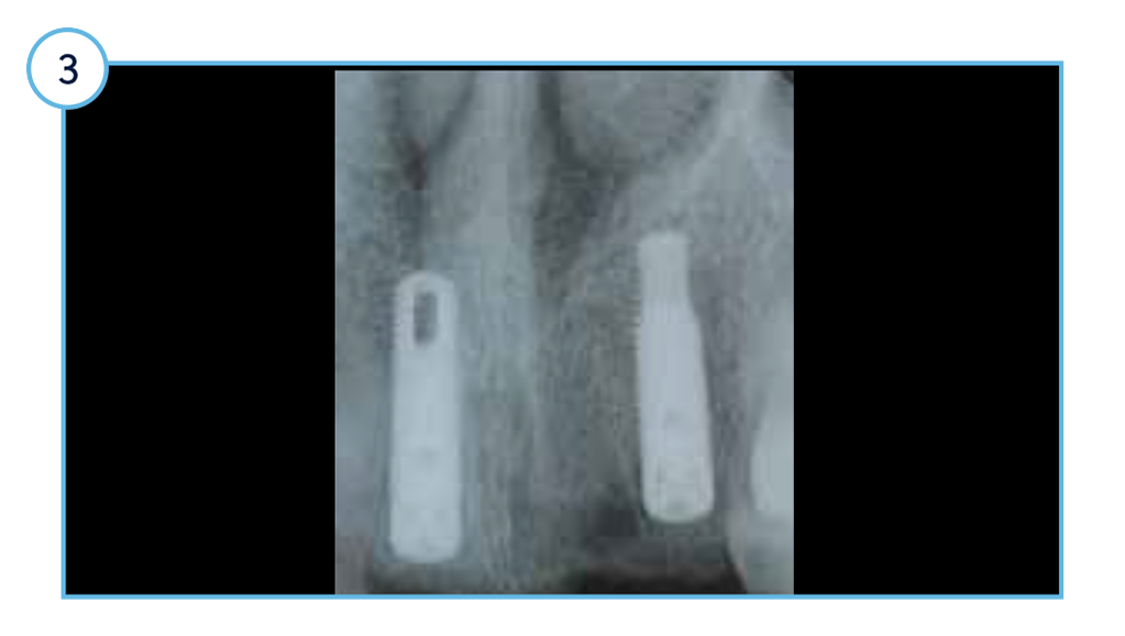 surgical cover screws attached.