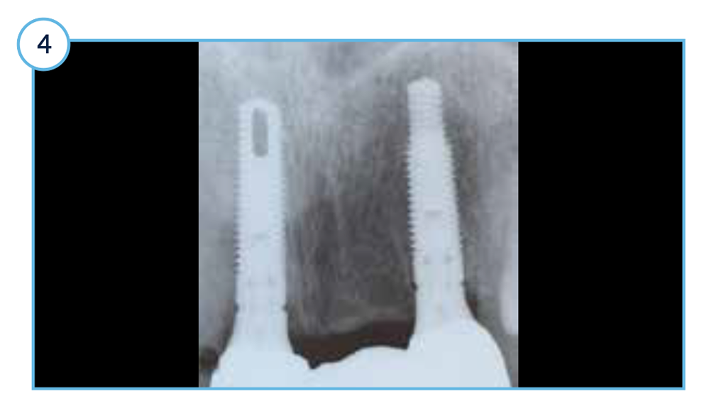 One-year post-placement radiograph with stable marginal bone levels around TSVT implants.
