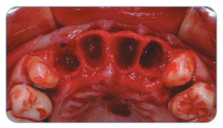 Fig. 1. Extraction sockets of the four maxillary incisors and immediate implant placement.