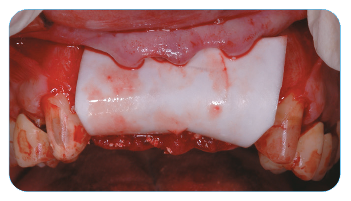 Fig. 2. Grafting with Endobon Xenograft Small Granules covered by an OsseoGuard® Resorbable Collagen Membrane.