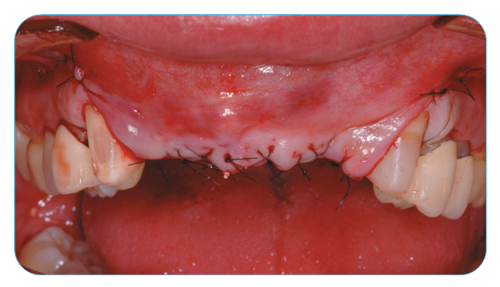 Fig. 3. The soft-tissue flaps were closed and sutured.