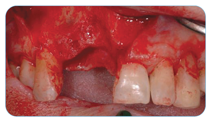 Fig. 7. Post-extraction defects in the maxilla right central and lateral incisor area. 