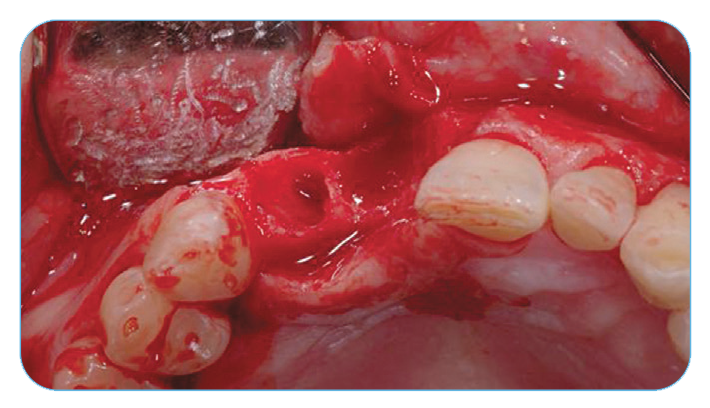 Fig. 8. Occlusal view of the extraction site defects..