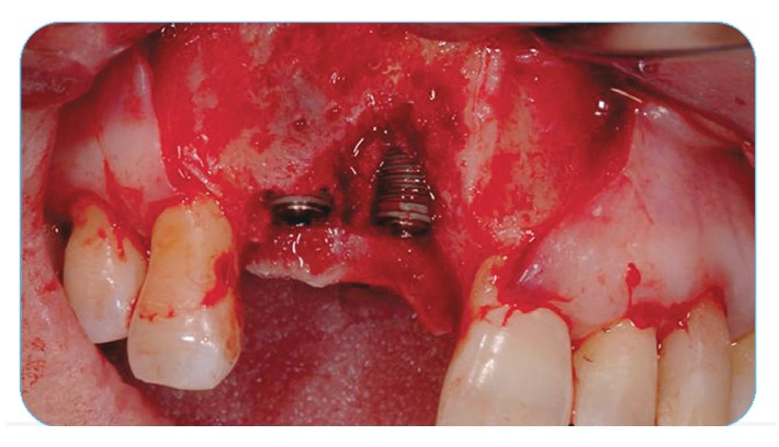 Fig. 9. Facial view of dehiscence defects after implant placement. 