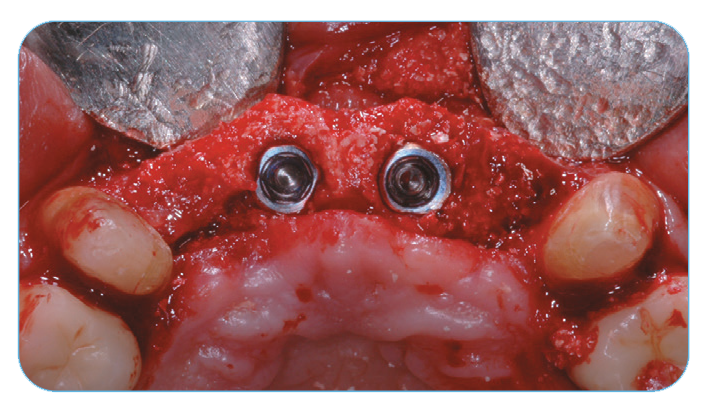 Fig. 6. Occlusal view after four months.