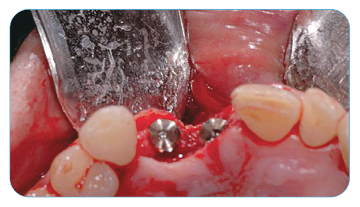 Fig. 10. Occlusal view of implants and defects.