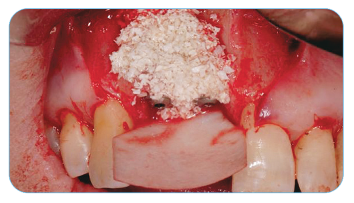 Fig. 11. Grafting with Endobon Xenograft Small Granules covered by an OsseoGuard Resorbable Collagen Membrane.