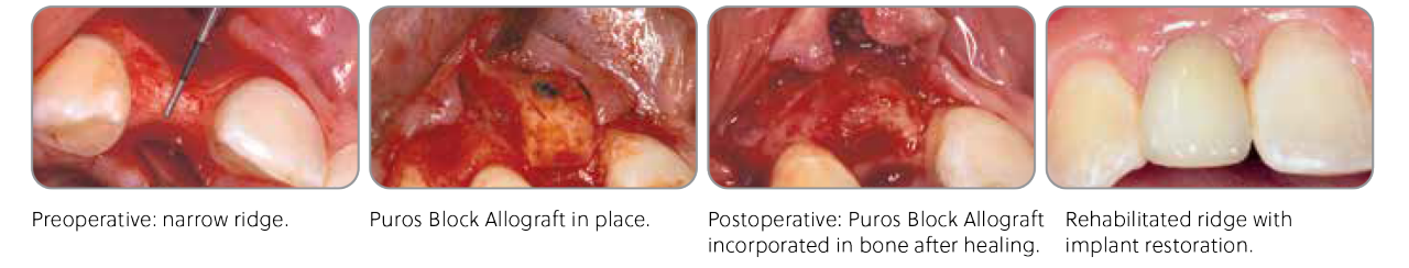 Clinical Advantages of Puros Block Allografts Case