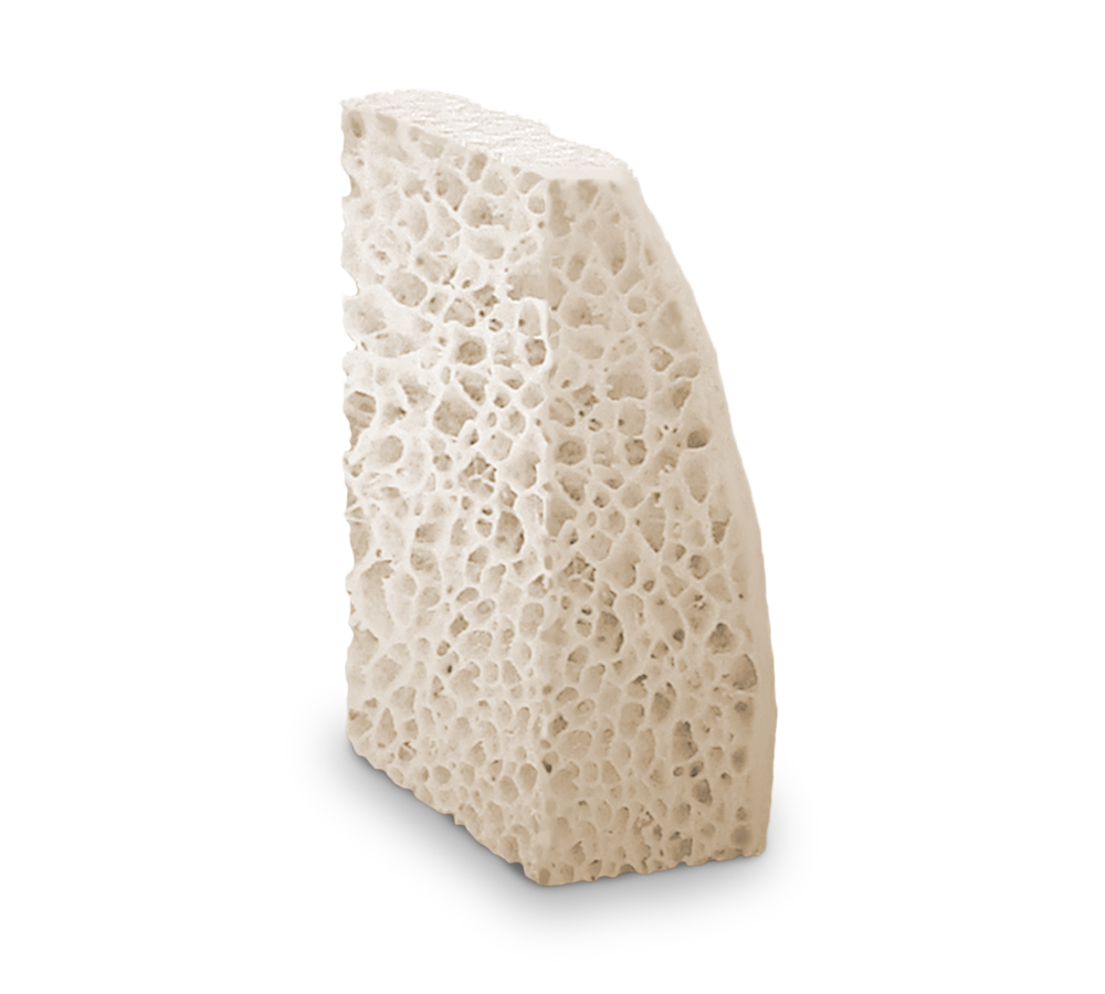 The Puros Allograft Block is a sterile, bone-grafting biomaterial used in dental surgery to restore severely resorbed ridges.