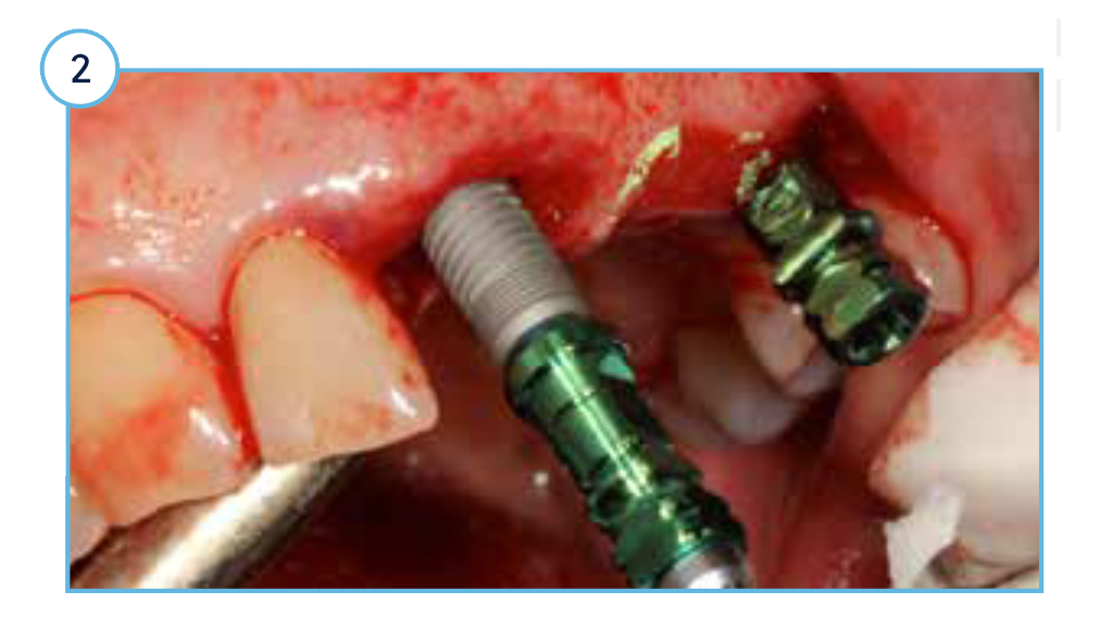 TSVT Implants (4.1 mm x 16 mm) with attached fixture mounts threaded into the prepared extraction sockets.