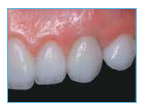 The final clinical photo showing the completed case, highlighting the excellent aesthetic value of both the natural tooth restorations and the implant-supported restoration.