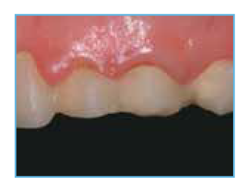 An initial clinical photo showing a 35-year-old female patient with a provisional restoration on teeth numbers 11-14 that she found unsatisfactory.