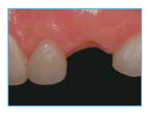 A clinical image of the patient's mouth after orthodontic treatment and the removal of the provisional restoration, showing the current state of the teeth and gums.