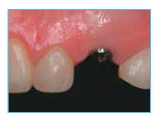 This figure shows a ZimVie Full Osseotite Tapered implant and a BellaTek Encoded Healing Abutment that have been placed to prepare for the final restoration.