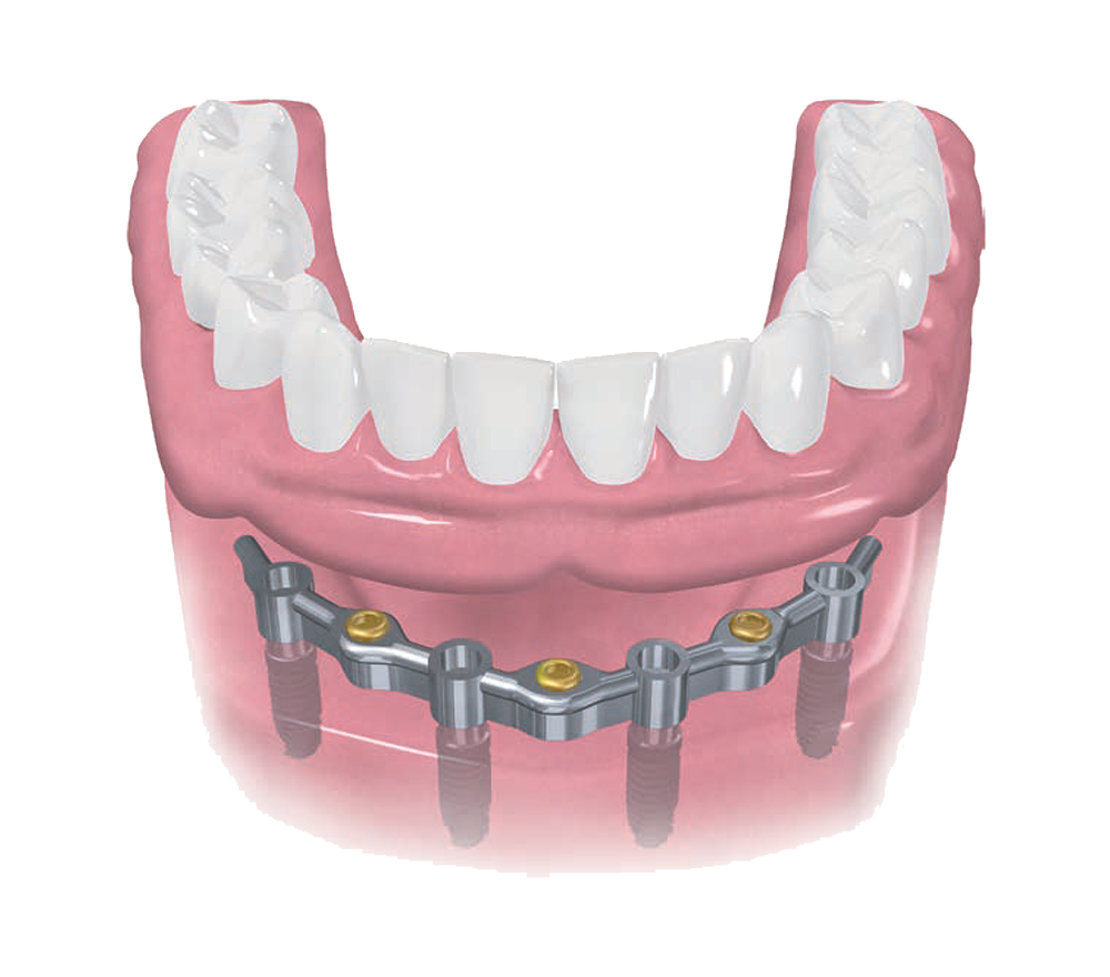 BellaTek Dental Bars