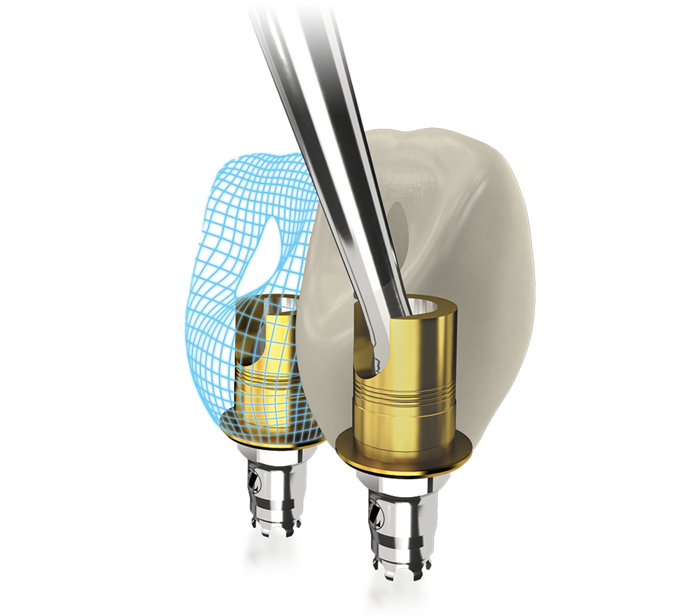 Express and Flex TiBase Abutments ZimVie Dental