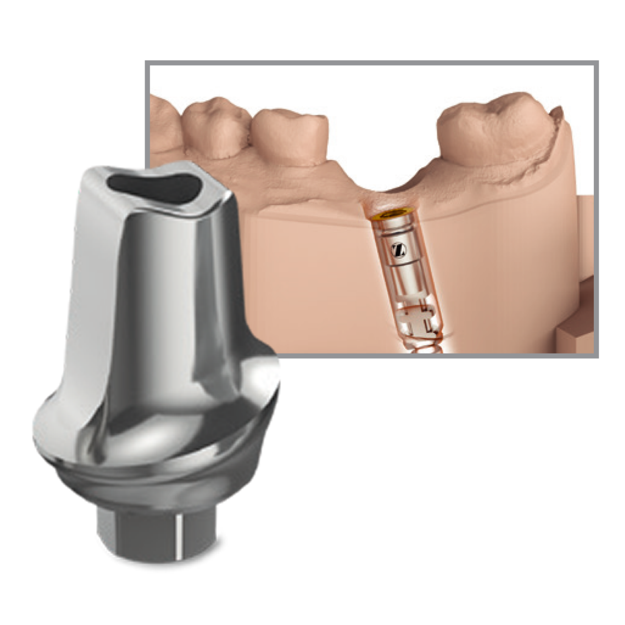 ZimVie mails a CAD/CAM abutment.