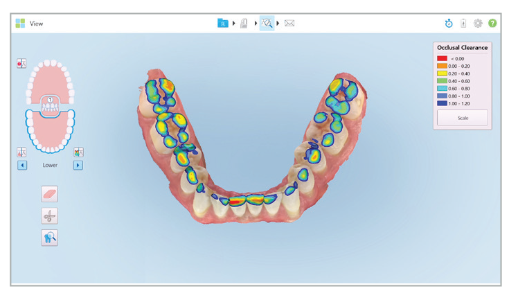 Occlusogram - Highlight contact relationship between arches with clear, color coded images.