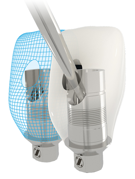 ZimVie Dental Certain TSV Bellatek Flex Express Abutment