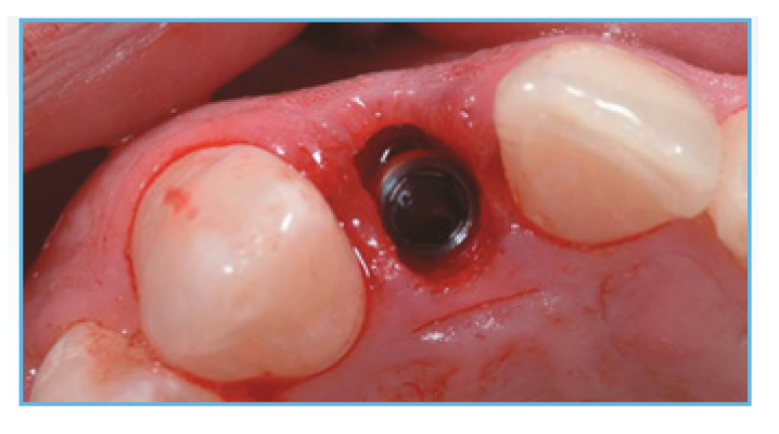 Fig.1. NanoTite Certain Implant in place The bone was profiled around the interface Fig. 1. NanoTite® Certain Implant in place. The bone was profiled around the interface.