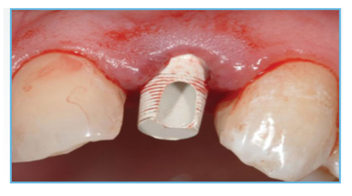 Fig.2 A PreFormance Post was seated into the implant Fig. 2. A PreFormance Post was seated into the implant.