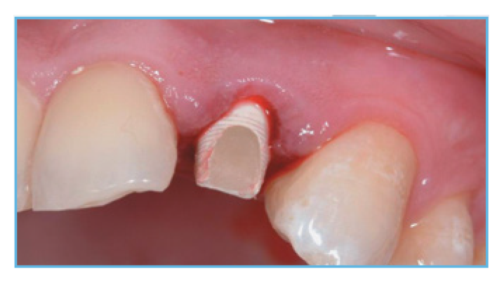Fig. 3. The PreFormance Post was prepared intraorally to follow the gingival contours Fig. 3. The PreFormance Post was prepared intraorally to follow the gingival contours.