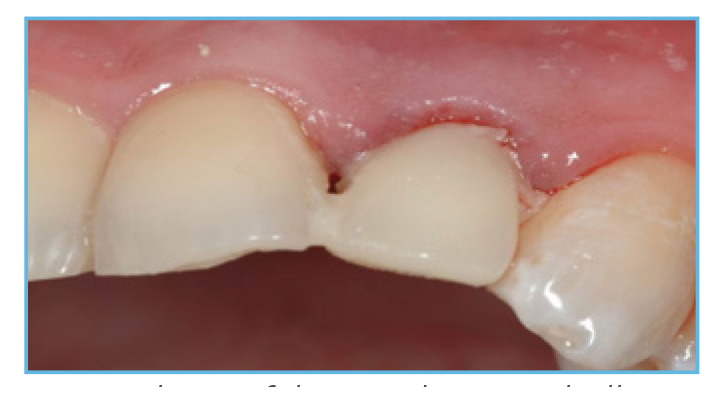 Fig.4. The prefabricated crown shell was luted to the PreFormance Post Fig. 4. The prefabricated crown shell was luted to the PreFormance Post.