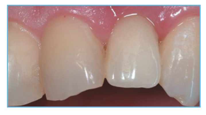 Fig.5. The provisional restoration was fabricated occlusal and interproximal contacts Fig. 5. The provisional restoration was fabricated, occlusal and interproximal contacts were checked, adjusted accordingly, and delivered to the patient.