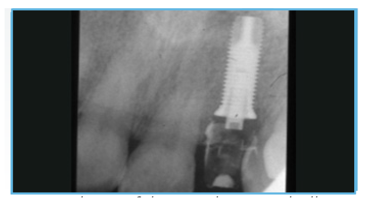 Fig. 6. Aperiapical radiograph was taken of the provisional restoration Fig. 6. A periapical radiograph was taken of the provisional restoration.